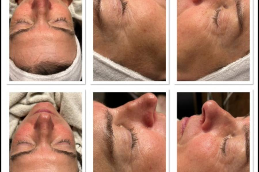 HYDRO-DERMABRASION  C'est le soin qui vous fait une peau neuve.